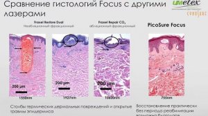 Cynosure PicoSure дерматологические возможности