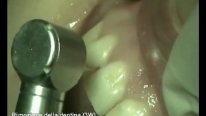 Препарирование эрбиевым лазером 12 зуба