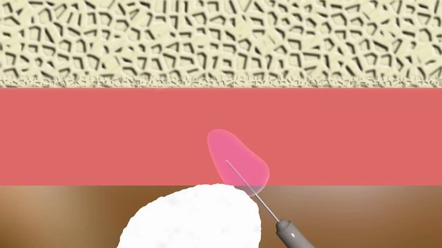 Безболезненная компьютерная анестезия смотреть онлайн