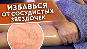 Как убрать сосудистую сетку на ногах?
Массаж от сосудистых звёздочек.