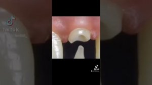 Спасение переднего зуба!