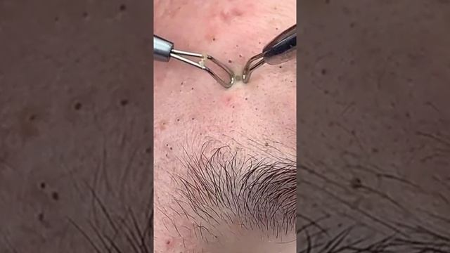 ЧИСТКА ЛИЦА.