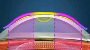 Как работают ночные линзы ок линзы?