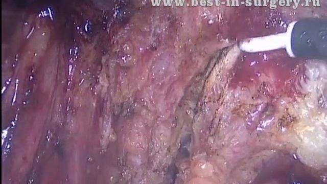 Ретроцервикальный эндометриоз IV степени с поражением кишки