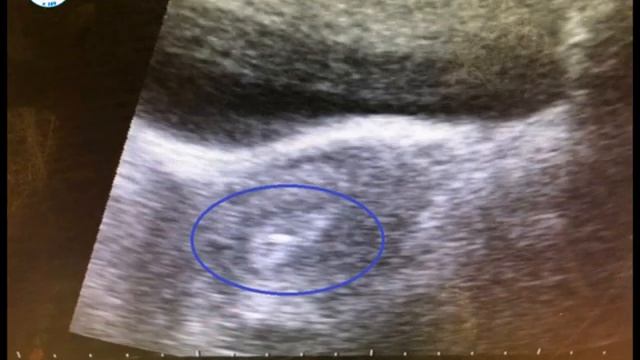 Эндометрий при переносе эмбриона. Эмбрион в матке после переноса на УЗИ. Как выглядит яйцеклетка на УЗИ. Матка после подсадки эмбрионов.