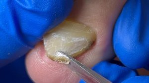Accidentally injured toenails, removal of excess ingrown nails【Xue Yidao】