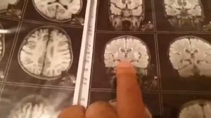 НОВЫЕ УСПЕХИ РАЙОНЫ В БОРЬБЕ С БОЛЕЗНЬЮ ВИЛЬСОНА КОНОВАЛОВА