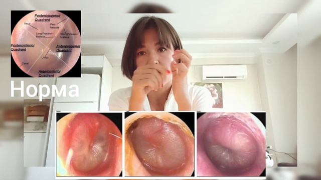 Острый (гнойный) средний отит - только самое важное! смотреть онлайн