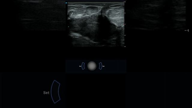 Гнойный МАСТИТ на УЗИ смотреть онлайн
