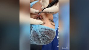 Удаление образования нижнего века.