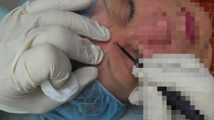 Невусы Мишера.