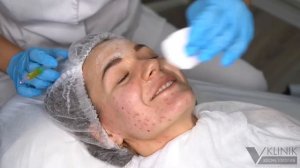 плазмотерапия лица / борьба с акне