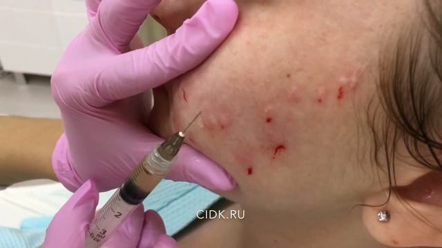 Коллост в ЦИДК смотреть онлайн