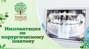 ? Имплантация по хирургическому шаблону