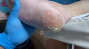 The soles of the feet are cracked a lot, and the feet are not washed【Pedicure Master Lin Jun】