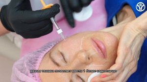 Коррекция носогубных складок, коррекция скул филлерами EPTQ: мастер класс пластического хирурга