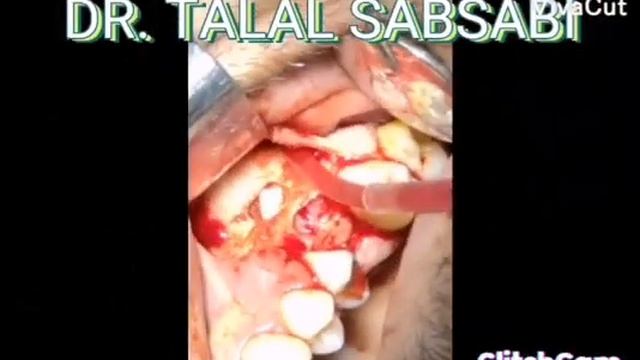 dental implant with external sinus lift смотреть онлайн