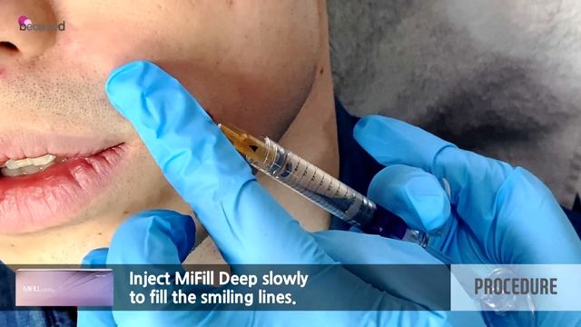 Live Demo : MiFill Deep/Smiling Lines смотреть онлайн