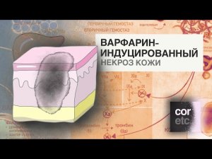 Варфарин-индуцированный некроз кожи