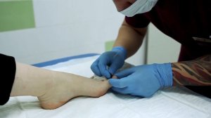 Перевязка после удаления вросшего ногтя