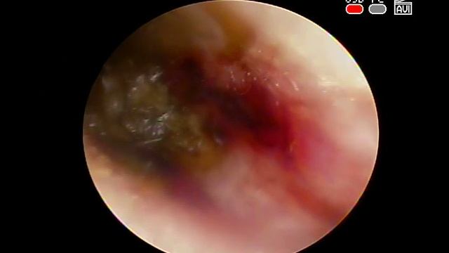 Посттравматический #отит на фоне #серной пробки #слухового прохода смотреть онлайн