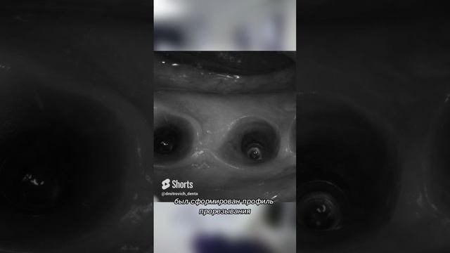 Клинический случай с одномоментной имплантацией