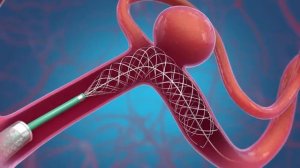 Эмболизация аневризмы головного мозга