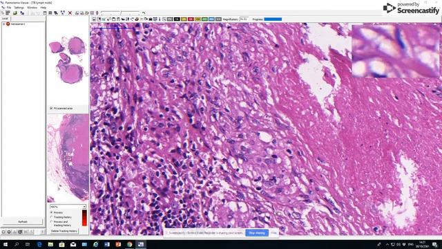 SWU Pathology: Talk Lab Hematopathology: Tuberculous lymphadenitis