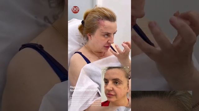 Результат Подтяжка бровей (БРОУЛИФТ)