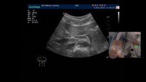 Ультразвуковая анатомия сосудов брюшной полости (демонстрация на пациенте)