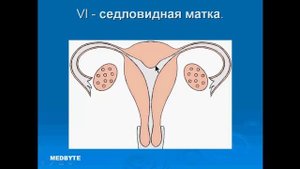 Аномалии матки, врожденные пороки и бесплодие.