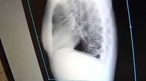 Бронхолегочные Заболевания: Бронхит, Астма, Воспаление Легких, Бронхоспазм, Обструктивный Бронхит