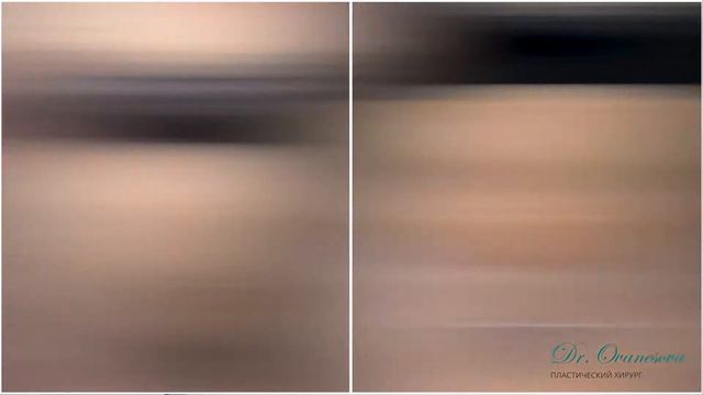 Липосакция. До и после. Пациент Н11. смотреть онлайн