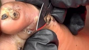 Jigger digging John Geza - big juicy jiggers were pulled out one by one, FULL VIDEO @.net