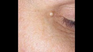 Жировик под глазом
