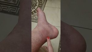 КРЕМ БЕЛОДЕРМ! ЭТОТ КРЕМ СПАС МОЮ НОЖКУ ОТ ТРОФИЧЕСКОЙ ЯЗВЫ! ДЕЛЮСЬ С ВАМИ СВОИМ ОПЫТОМ! ?