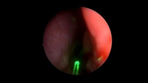 Лазерлі мұрын кеуілжір редукциясы (Лазерная редукция носовых раковин)