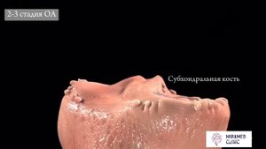Этапы развития ОСТЕОАРТРОЗА коленного сустава