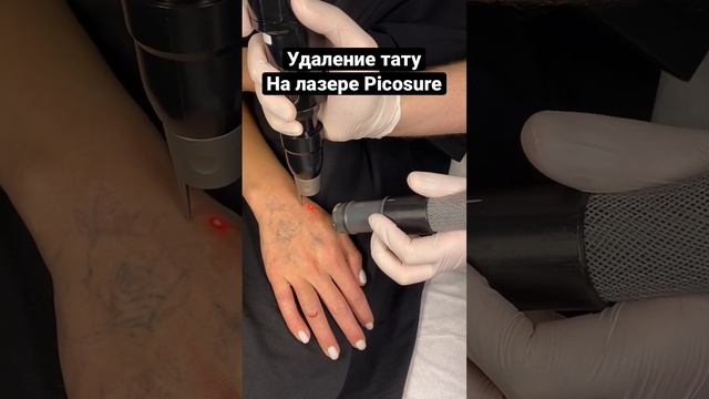 Процесс удаления татуировки на лазере Picosure #shorts