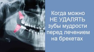 Когда можно не удалять зубы мудрости перед ортодонтическим лечением?