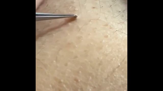 Relax Every Day ?Самое залипательное видео давить угри Dermatologist.video to press pimples АКНЕ