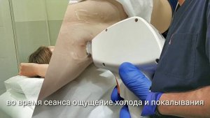 Лазерная эпиляция подмышек