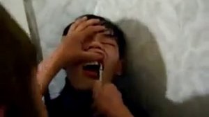 Удаление зуба по-якутски. Жестко