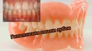 Гипоплазия эмали зубов
