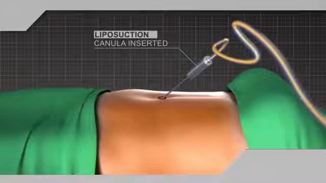 ЛИПОСАКЦИЯ В МОСКВЕ. Удаление излишков жировых | Столярж Алексей Борисович смотреть онлайн