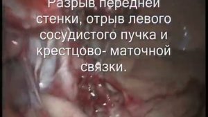 Ушитый разрыв матки в родах. Контрольная лапароскопия и гистероскопия.