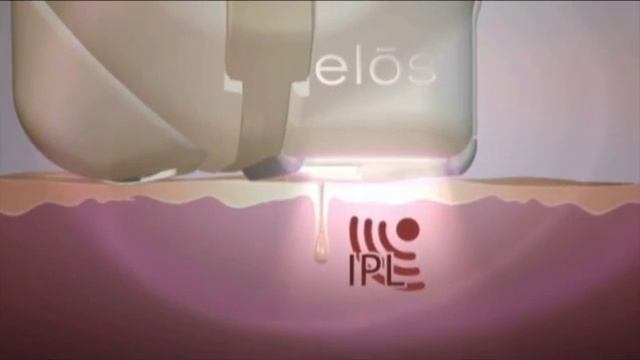 действие фотоэпилятора смотреть онлайн