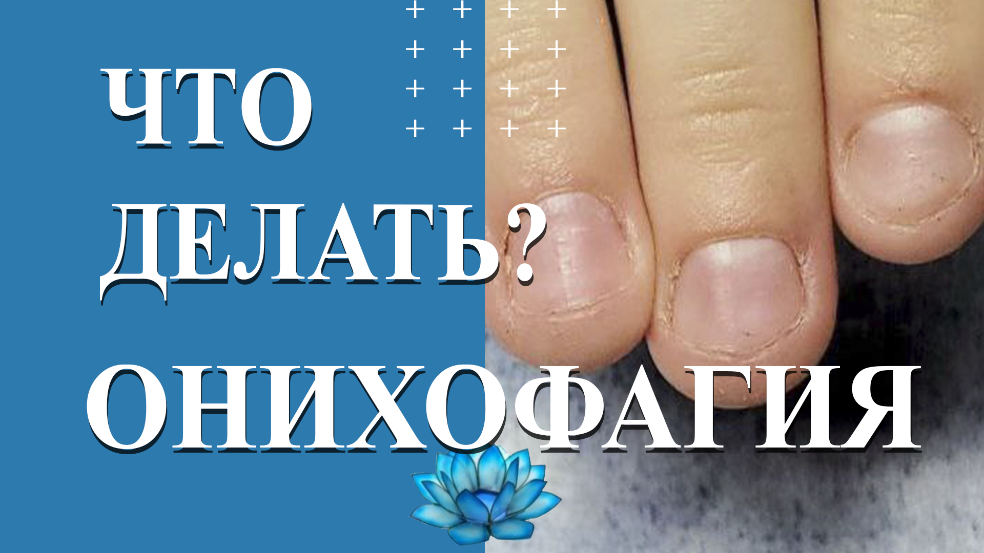 Онихофагия. Что это? Коррекция ногтей на обгрызанные ногти.