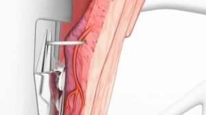 Проктология. Дезартеризация внутренних геморроидальных узлов.