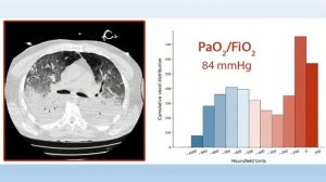 Как вентилировать Covid 19 по Gattinoni Горячев А.С